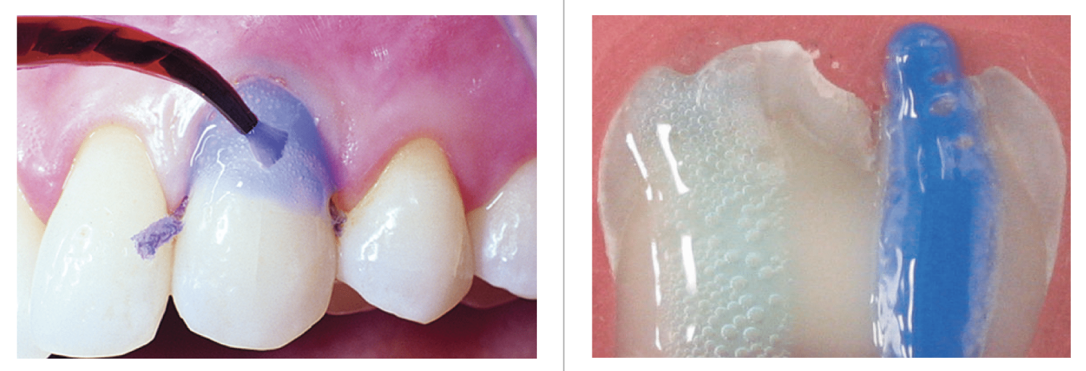 Axit xoi mòn men và ngà răng Etching Ultra Etch 35% Ultradent